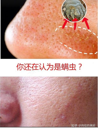 后背长了脂肪粒怎么办 后背长了脂肪粒怎么办