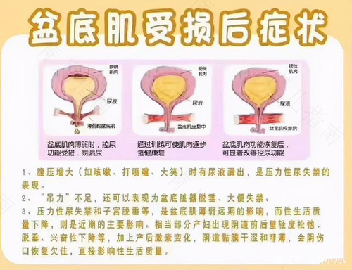 孕晚期子宫脱垂会有什么症状 孕晚期子宫脱垂会有什么症状