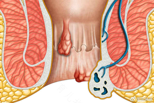 痔疮手术脱落期疼吗