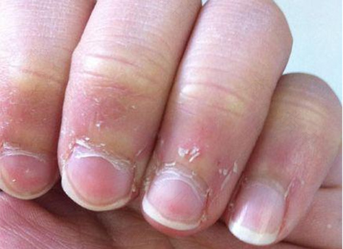 坐月子手指长倒刺是怎么回事 坐月子手指长倒刺是怎么回事