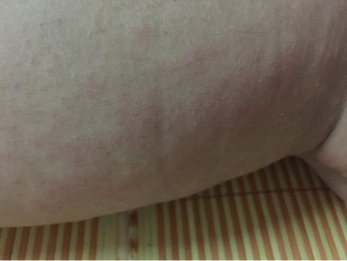 季节性过敏怎么办 季节性过敏怎么办