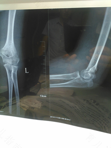 左肱骨骨折会有后遗症吗 左肱骨骨折会有后遗症吗