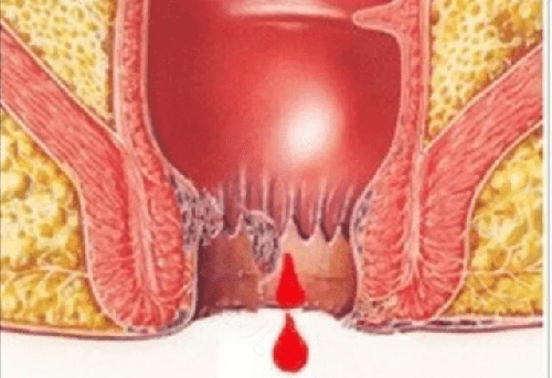 痔疮痒是怎么回事 痔疮痒是怎么回事