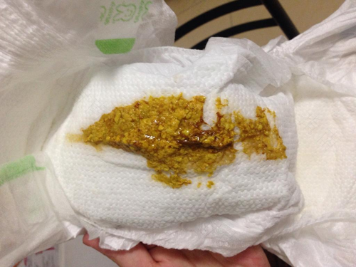 消化不良的腹泻有什么症状 消化不良的腹泻有什么症状