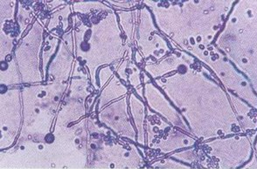 白色念珠菌症状图片 白色念珠菌症状图片