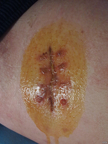 缝合好的伤口裂开了怎么办 缝合好的伤口裂开了怎么办