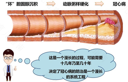 冠心病与急性冠脉综合征的区别 冠心病与急性冠脉综合征的区别