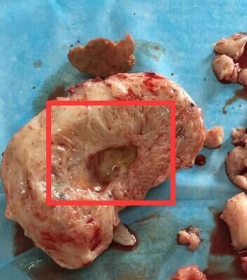 子宫肌腺症会不会病变 子宫肌腺症会不会病变