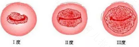 宫颈轻糜样改变怎么办 宫颈轻糜样改变怎么办