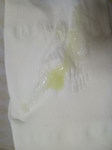 白带有点像脓一样是什么原因 白带有点像脓一样是什么原因