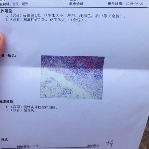 12度慢性宫颈炎严重吗 12度慢性宫颈炎严重吗