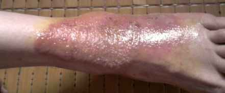 脚上过敏起水泡怎么办 脚上过敏起水泡怎么办