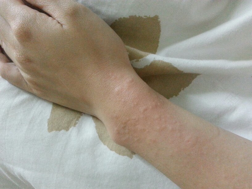 湿疹治好了还会复发吗