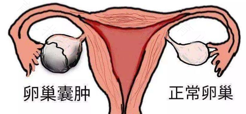 卵巢囊肿鸡蛋能吃吗 卵巢囊肿鸡蛋能吃吗