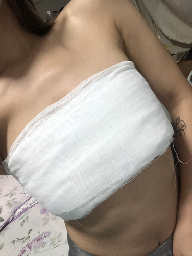 副乳可以做手术吗 会留疤吗 副乳可以做手术吗 会留疤吗