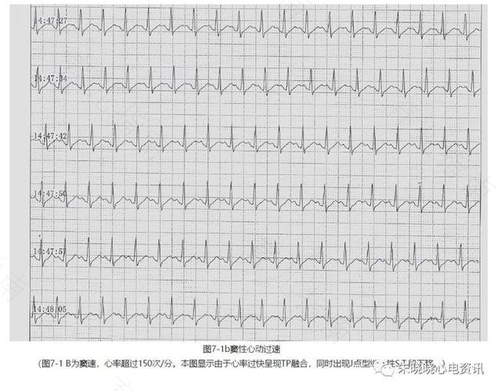 孕期窦性心律过速严重吗 孕期窦性心律过速严重吗