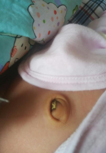 小孩肚脐周围硬硬的正常吗