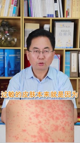 喝酒皮肤过敏瘙痒怎么办 喝酒皮肤过敏瘙痒怎么办