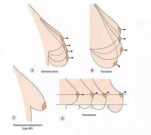 男孩子乳头大怎么回事 男孩子乳头大怎么回事