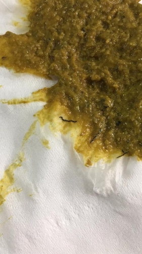 女人分泌物腥臭味怎么回事 女人分泌物腥臭味怎么回事