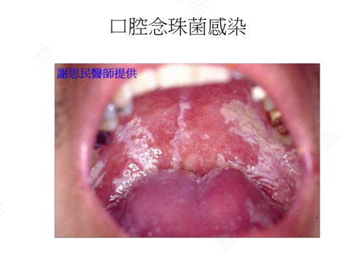 什么是口腔念珠菌感染症状 什么是口腔念珠菌感染症状