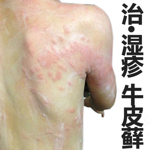 有湿疹如何治疗 有湿疹如何治疗