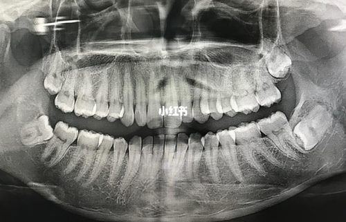 智齿长在上面最里面的地方好拔吗 智齿长在上面最里面的地方好拔吗