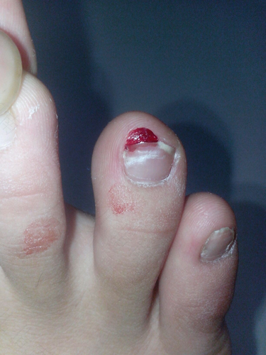 脚趾甲中间裂开了怎么办 脚趾甲中间裂开了怎么办