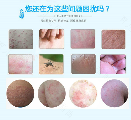 阴部湿热瘙痒怎么办 阴部湿热瘙痒怎么办