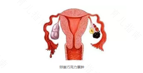 子宫直肠陷窝一是什么意思 子宫直肠陷窝一是什么意思