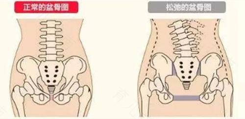 腰胯部疼痛是怎么回事女性 腰胯部疼痛是怎么回事女性