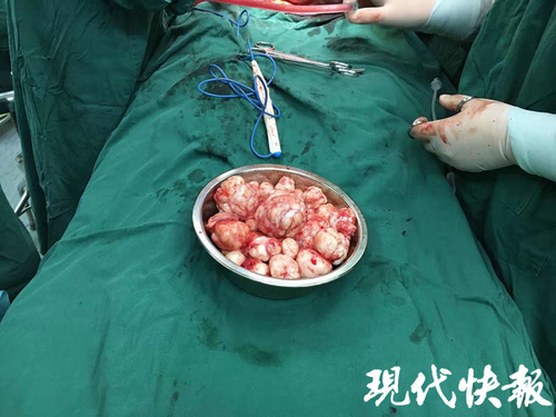 老年人子宫肌瘤需要手术吗 老年人子宫肌瘤需要手术吗