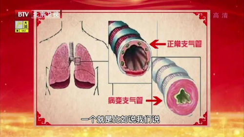得了肺炎会怎么样 得了肺炎会怎么样