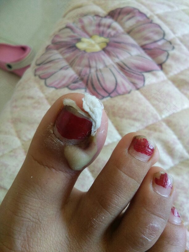 甲沟炎红肿有脓怎么办还痛 甲沟炎红肿有脓怎么办还痛