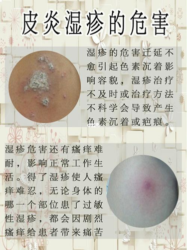 怎么治疗湿疹有效的 怎么治疗湿疹有效的