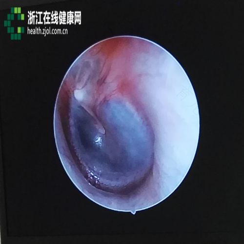 有耳屎掉到耳膜怎么办 有耳屎掉到耳膜怎么办