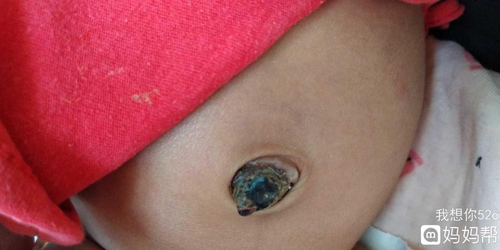 肚脐里有硬块怎么回事