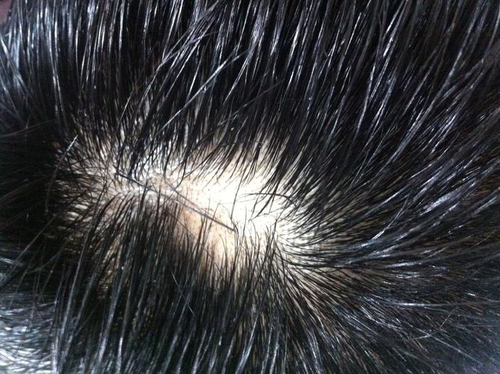 斑秃脱发怎么治