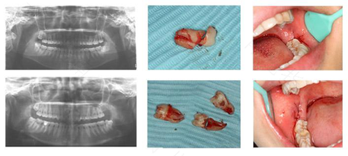 拔牙后晚上一直出血怎么办 拔牙后晚上一直出血怎么办