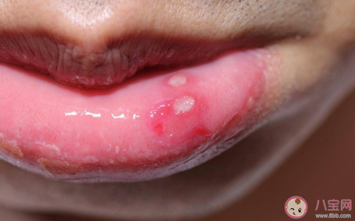 老是爱长口腔溃疡是怎么回事 老是爱长口腔溃疡是怎么回事