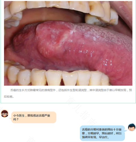 舌头上溃疡怎么治好得快 舌头上溃疡怎么治好得快