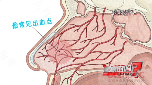 鼻子血管破裂了怎么办 鼻子血管破裂了怎么办
