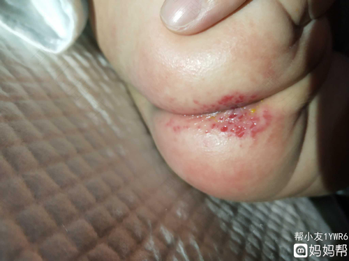 擦破皮一直出水怎么办 擦破皮一直出水怎么办