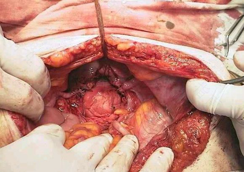 做完手术一直不拉屎怎么办 做完手术一直不拉屎怎么办