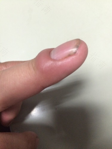 手指肿胀是怎么回事? 手指肿胀是怎么回事?