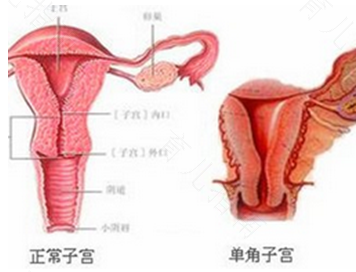 先天性没有子宫能治吗 先天性没有子宫能治吗