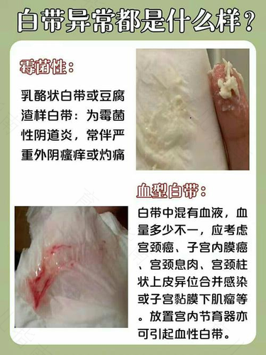 妇科炎症有哪些症状 妇科炎症有哪些症状