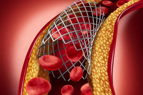 早期冠心病怎么治疗好 早期冠心病怎么治疗好