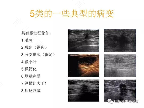 副乳结节会不会癌变 副乳结节会不会癌变