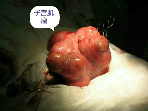 怀孕了检查出有子宫肌瘤怎么办 怀孕了检查出有子宫肌瘤怎么办